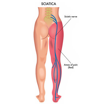 Sciatica